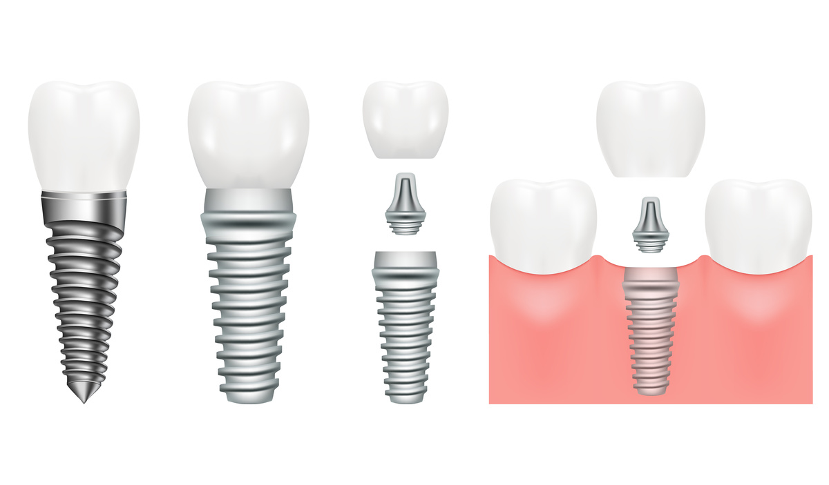 Realistic dental implant structure with all parts crown, abutment, screw. Dentistry. Implantation of human teeth. Vector illustration, eps 10
