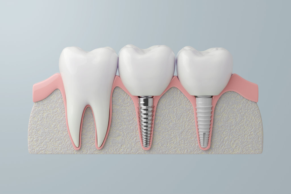 Osseointegration and Dental Implant Types